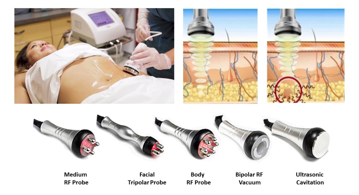 Face Contouring, Mesotherapy including RF skin tightening and