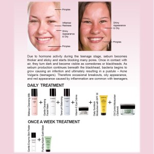 BC - Hannon - Acne-Prone Skin