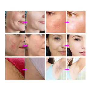 HiTechBeauty - OPT SHR E-Light (RF & IPL) Hair Removal & Skin Rejuvenation Machine - 500K shots - Image 10
