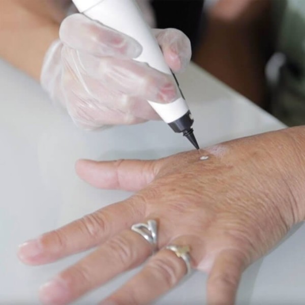 Full Vial - (60 sec) Cryotherapy (Accuret)