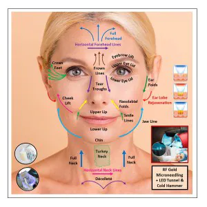 RF Gold Microneedling (Fire & Ice) - Chin & Full Front Neck
