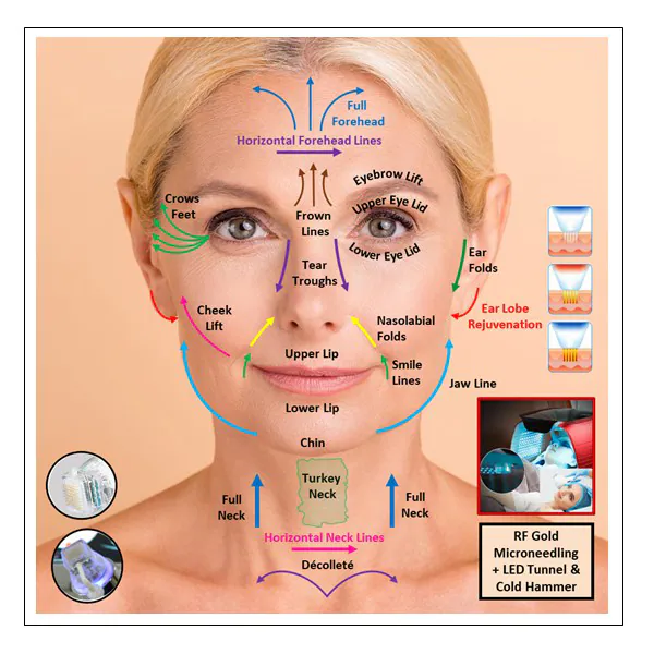 RF Gold Microneedling (Fire & Ice) - Forehead & Frown Lines