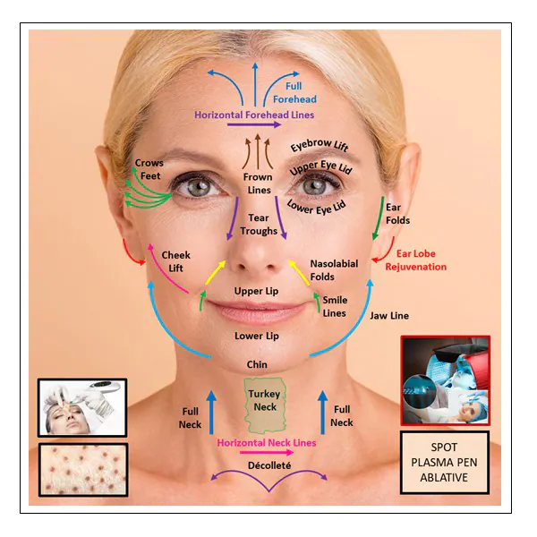 Ablative Plasma Lower Facelift
(Jaw line tightening, Full Mouth Area, Chin)